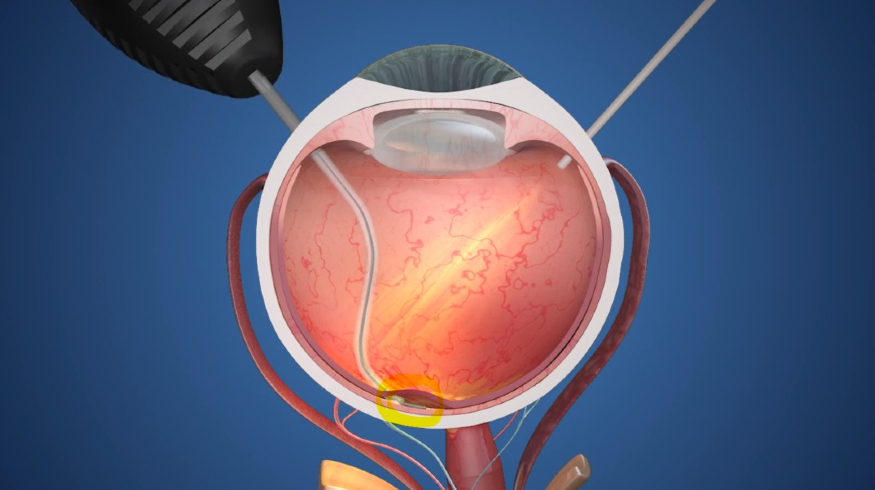 PRIMA 망막 임플란트.jpg PRIMA 망막 임플란트.jpg